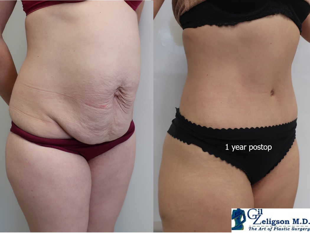 Dr. Gil Zeligson - Tummy Tuck Abdomino plasty