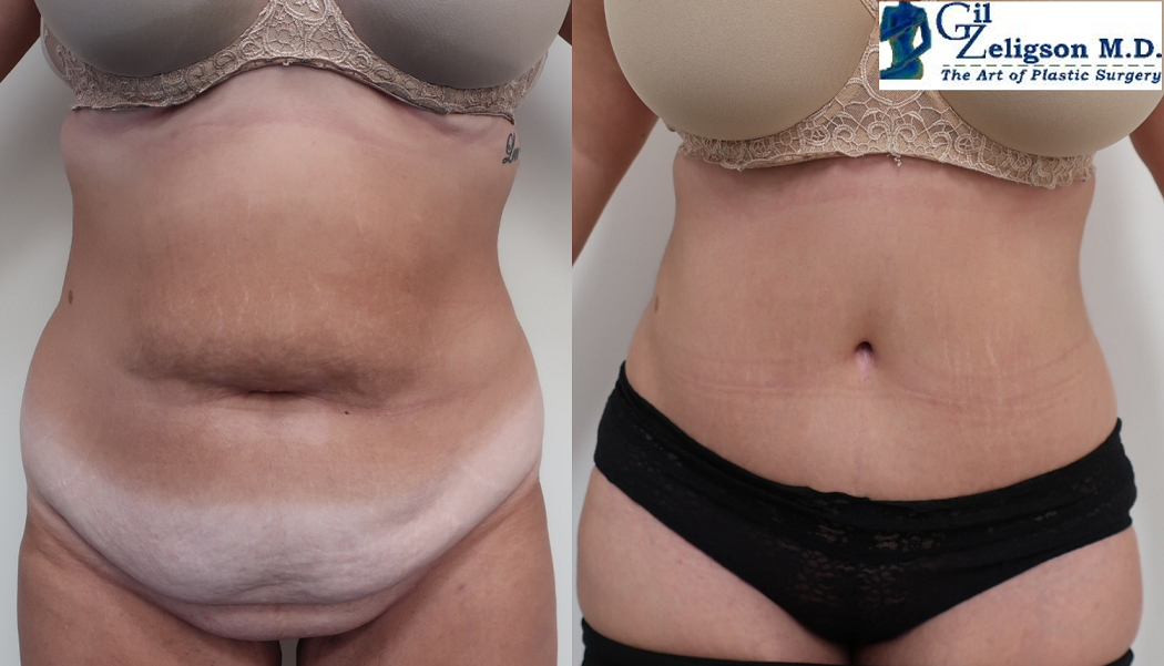 Dr. Gil Zeligson - Tummy Tuck Abdomino plasty
