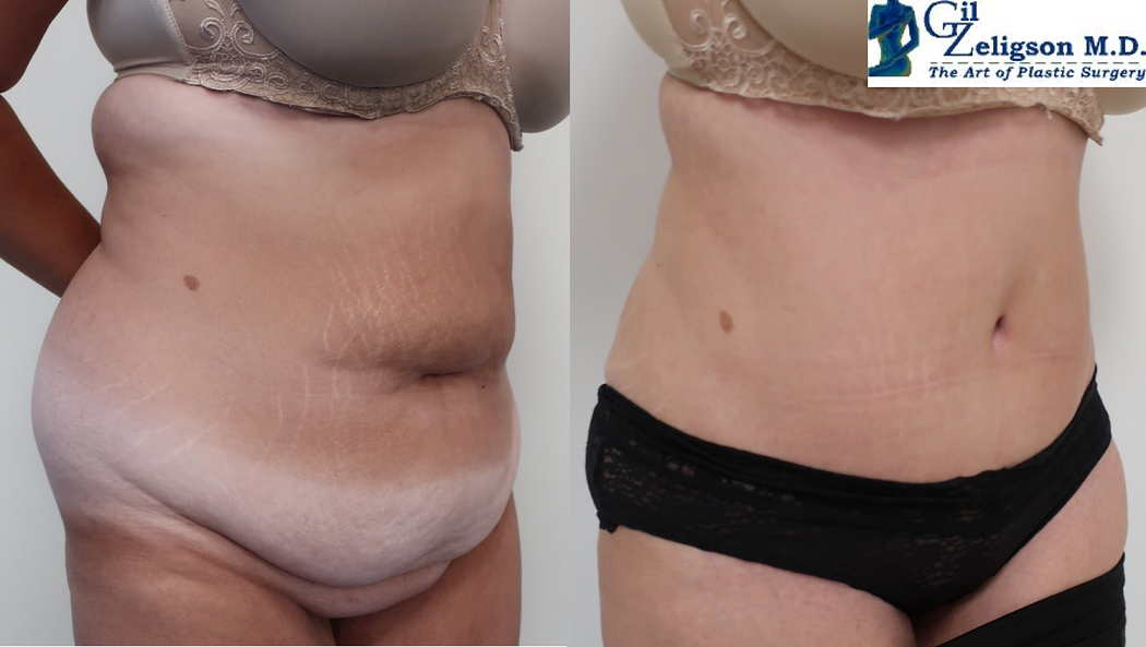Dr. Gil Zeligson - Tummy Tuck Abdomino plasty