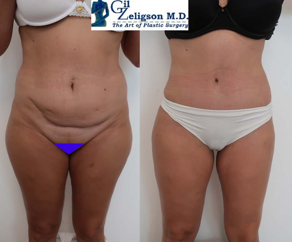 Dr. Gil Zeligson - Tummy Tuck Abdomino plasty