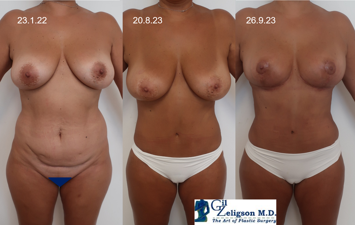 Dr. Gil Zeligson - Breast Reduction