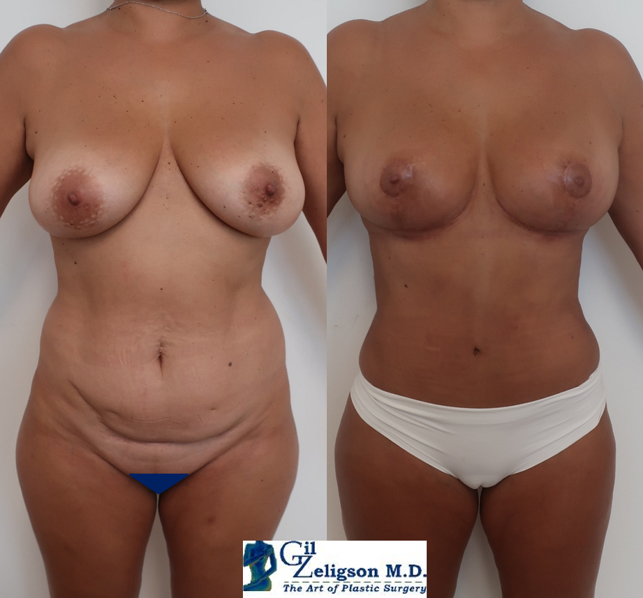 Dr. Gil Zeligson - Tummy Tuck Abdomino plasty