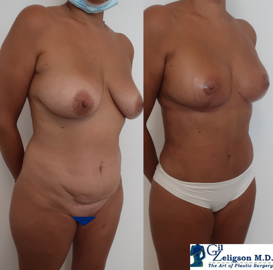 Dr. Gil Zeligson - Tummy Tuck Abdomino plasty