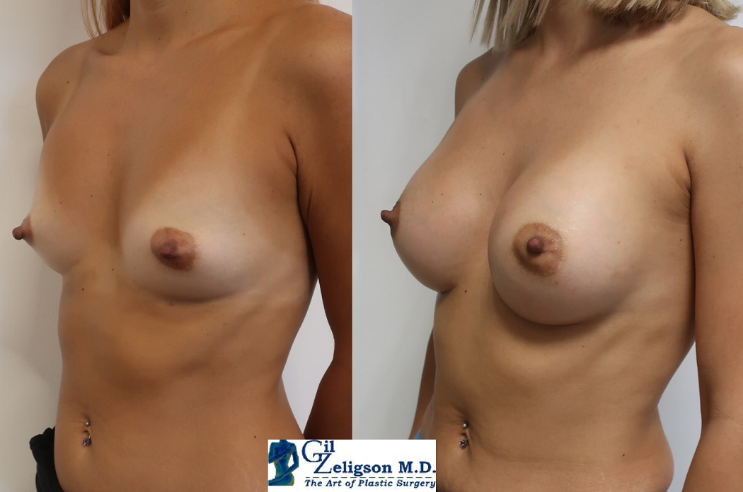 Dr. Gil Zeligson - Breast augmentation