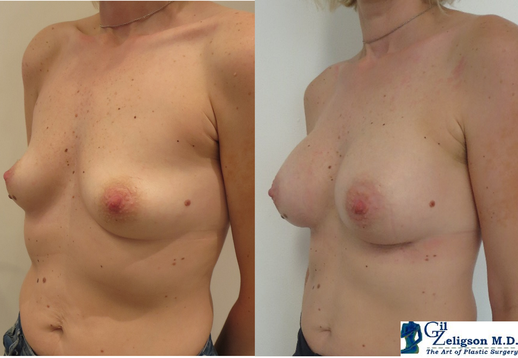 Dr. Gil Zeligson - Breast augmentation