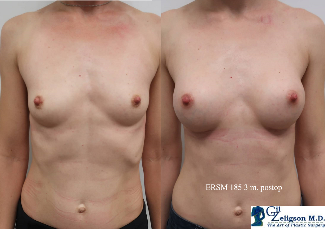 Dr. Gil Zeligson - Breast augmentation