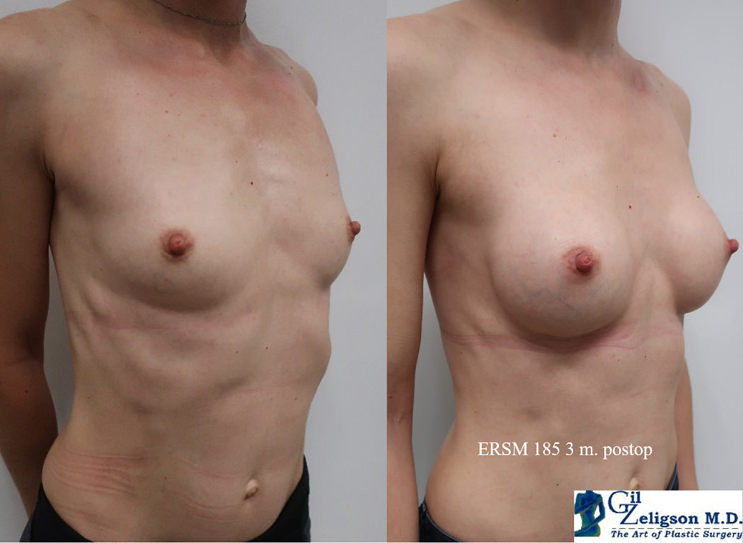 Dr. Gil Zeligson - Breast augmentation