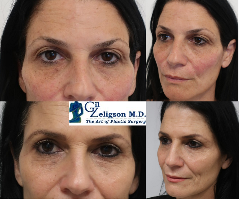 Dr. Gil Zeligson - Upper and Lower Eyelids