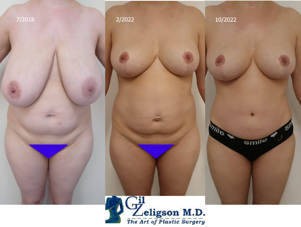 Dr. Gil Zeligson - Breast Reduction