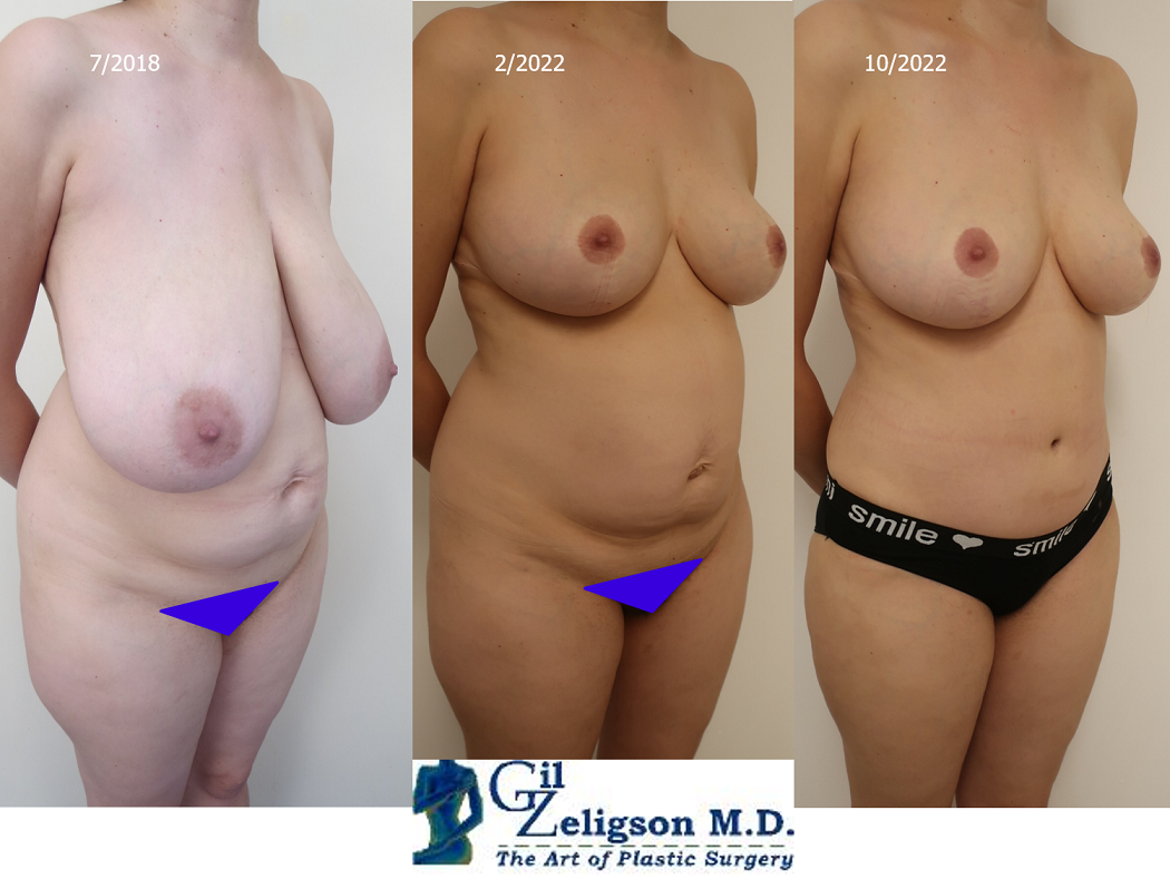 Dr. Gil Zeligson - Breast Reduction