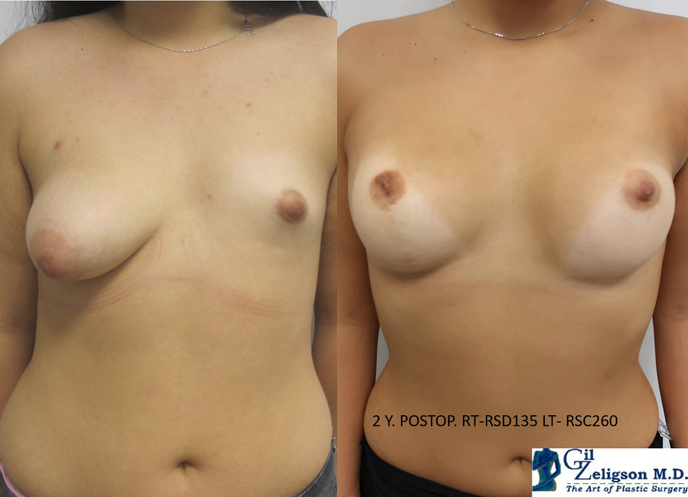 Dr. Gil Zeligson - Breast Asymmetry Correction