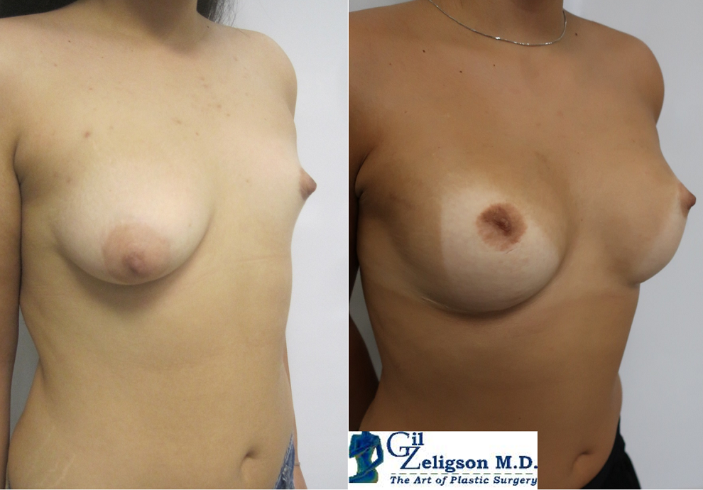 Dr. Gil Zeligson - Breast Asymmetry Correction