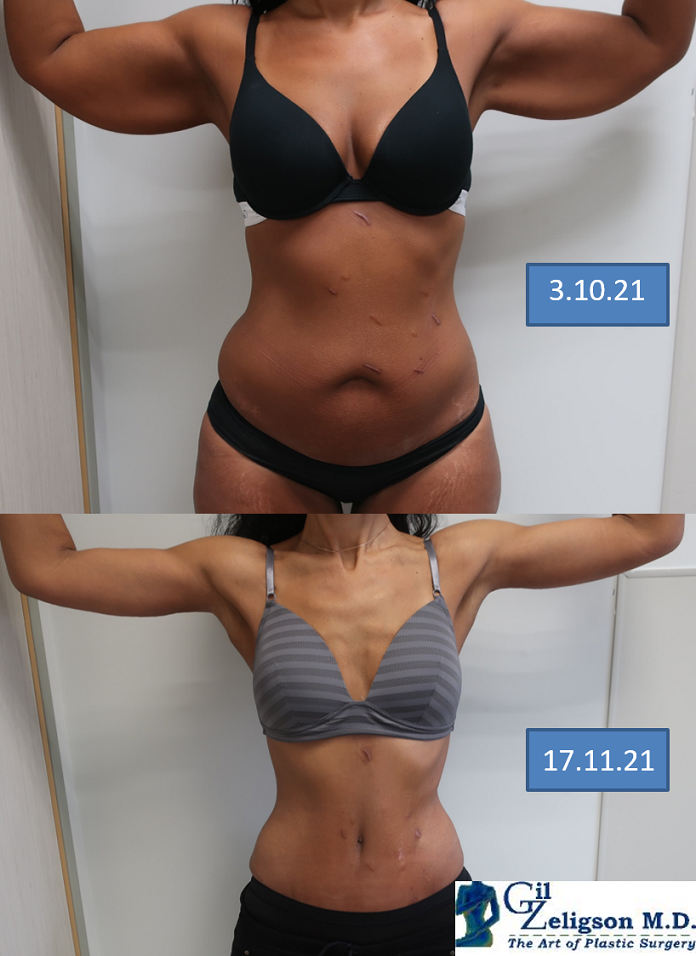 Dr. Gil Zeligson - Tummy Tuck Abdomino plasty
