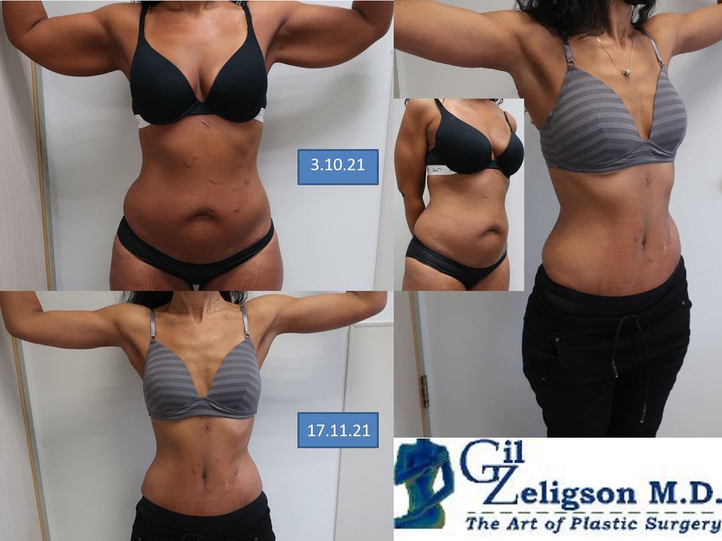 Dr. Gil Zeligson - Tummy Tuck Abdomino plasty