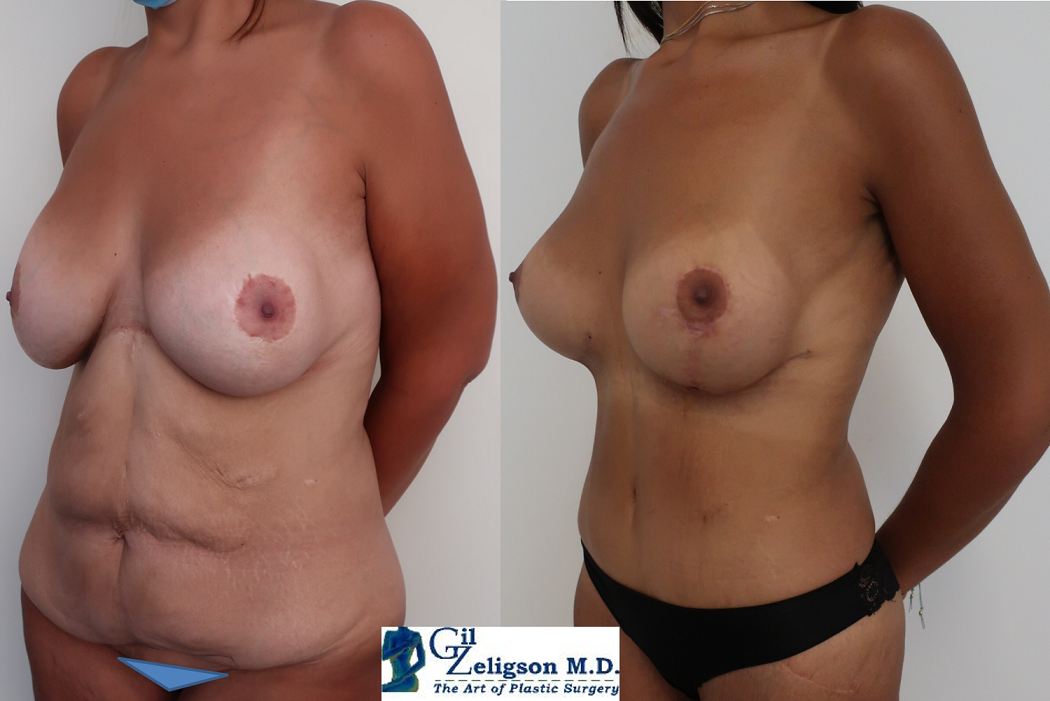Dr. Gil Zeligson - Tummy Tuck Abdomino plasty