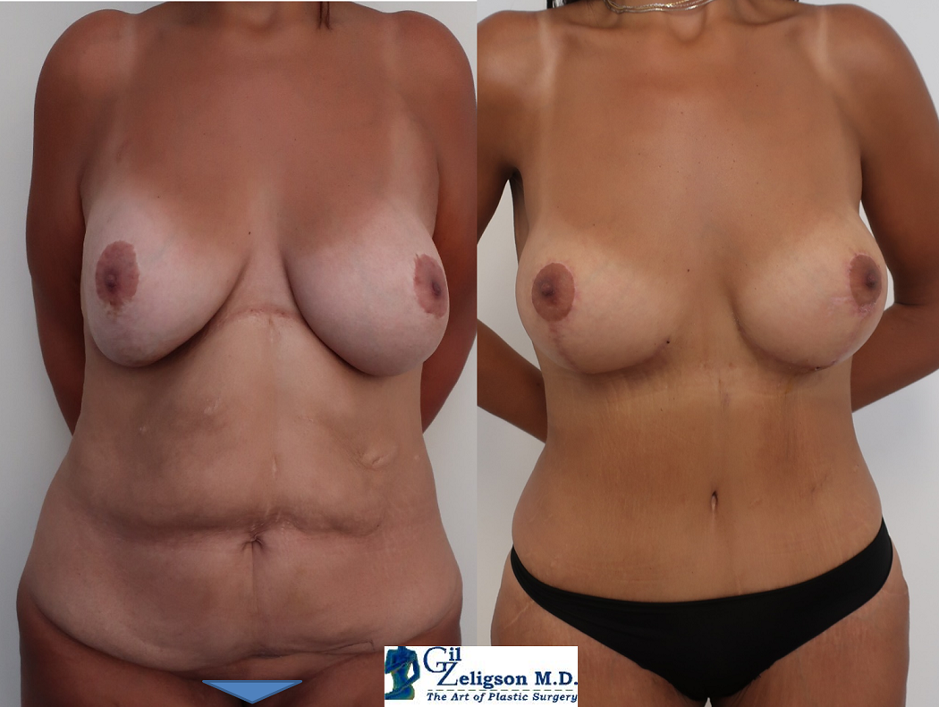 Dr. Gil Zeligson - Tummy Tuck Abdomino plasty