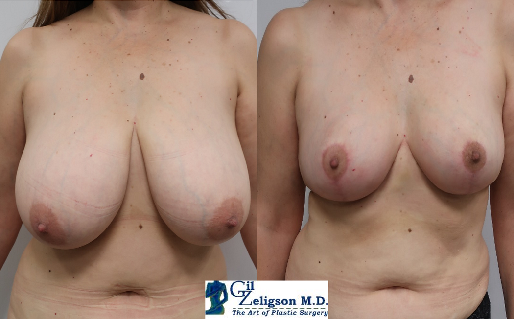 Dr. Gil Zeligson - Breast Reduction