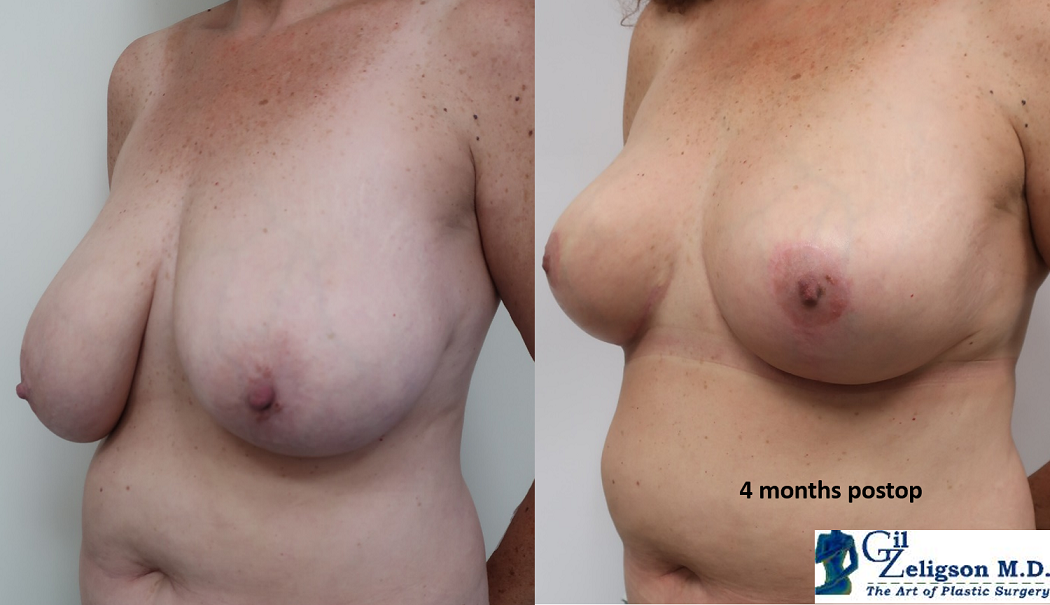 Dr. Gil Zeligson - Breast Reduction