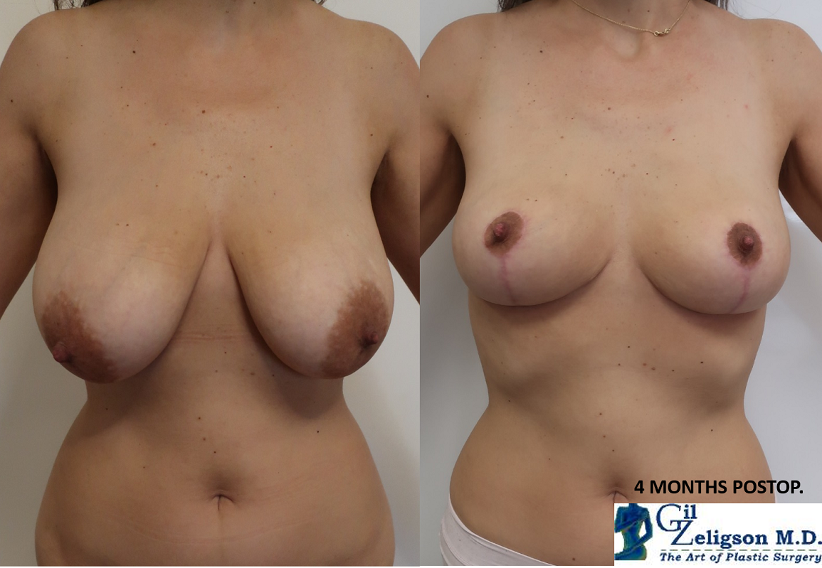 Dr. Gil Zeligson - Breast Reduction