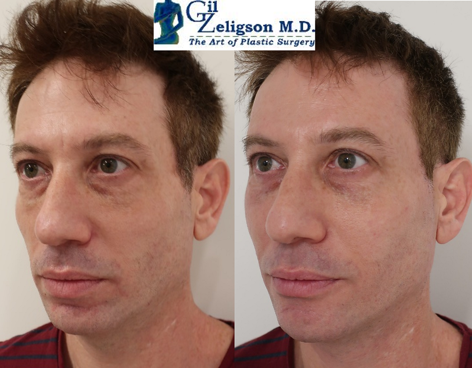 Dr. Gil Zeligson - Facial Sculpturing Hyaluronic acid