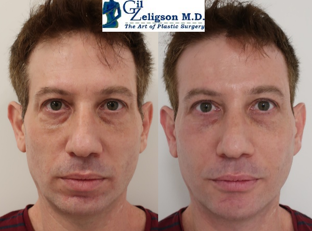 Dr. Gil Zeligson - Facial Sculpturing Hyaluronic acid