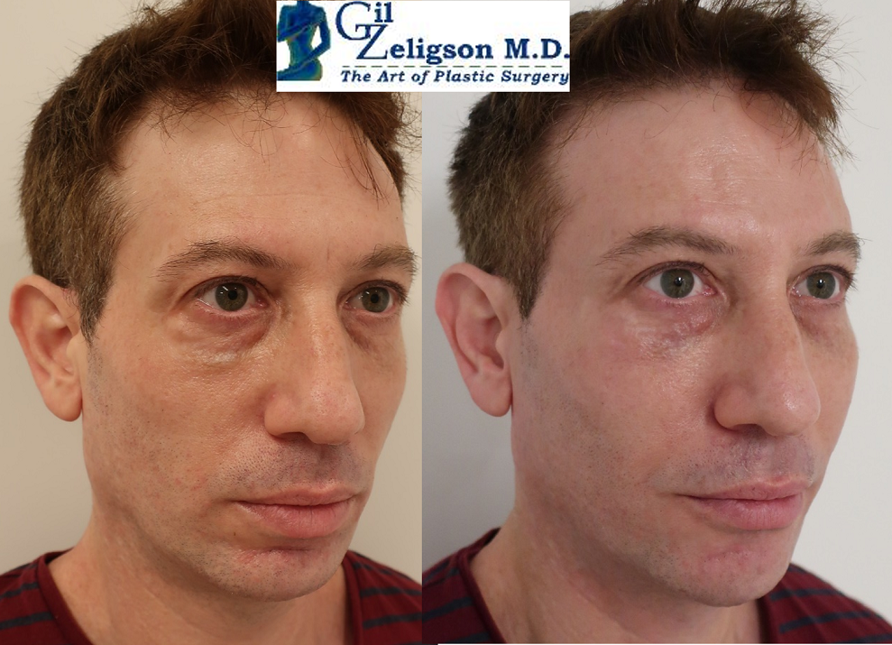 Dr. Gil Zeligson - Facial Sculpturing Hyaluronic acid