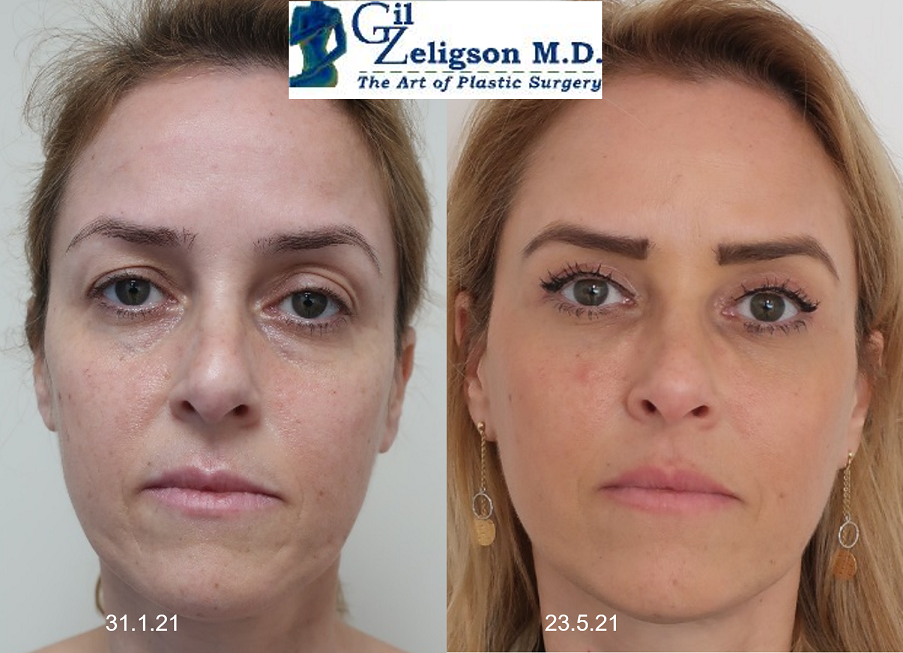 Dr. Gil Zeligson - Facial Sculpturing Hyaluronic acid