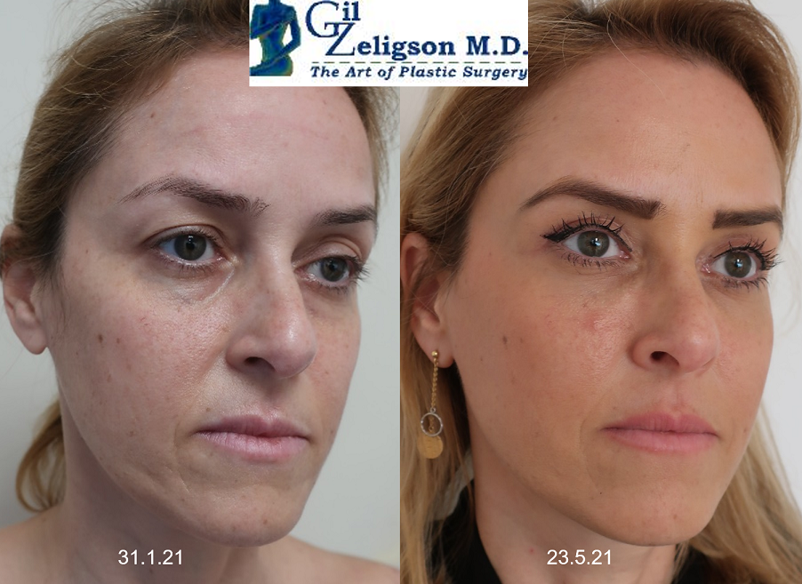 Dr. Gil Zeligson - Facial Sculpturing Hyaluronic acid