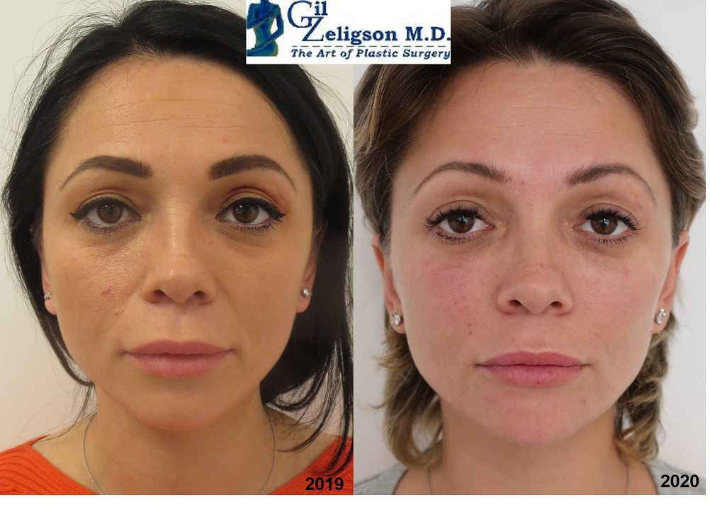 Dr. Gil Zeligson - Facial Sculpturing Hyaluronic acid