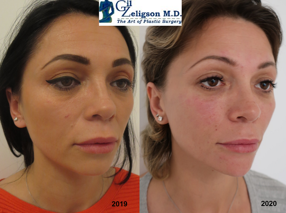 Dr. Gil Zeligson - Facial Sculpturing Hyaluronic acid