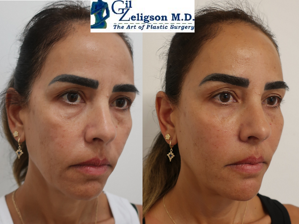 Dr. Gil Zeligson - Facial Sculpturing Hyaluronic acid