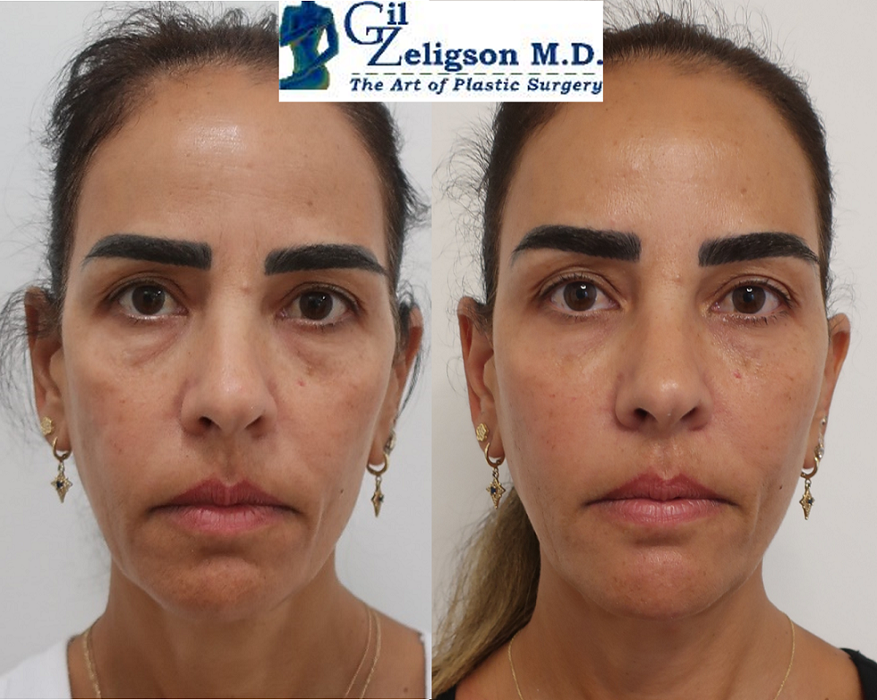 Dr. Gil Zeligson - Facial Sculpturing Hyaluronic acid
