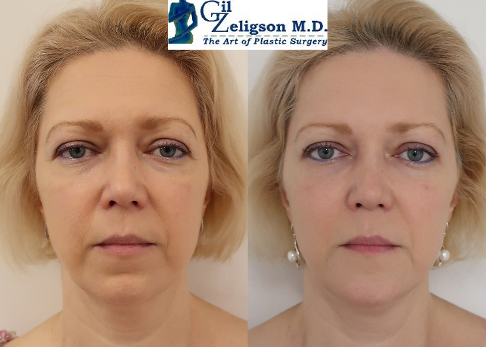 Dr. Gil Zeligson - Facial Sculpturing Hyaluronic acid