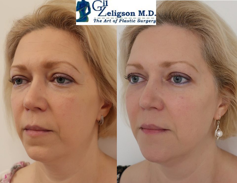 Dr. Gil Zeligson - Facial Sculpturing Hyaluronic acid