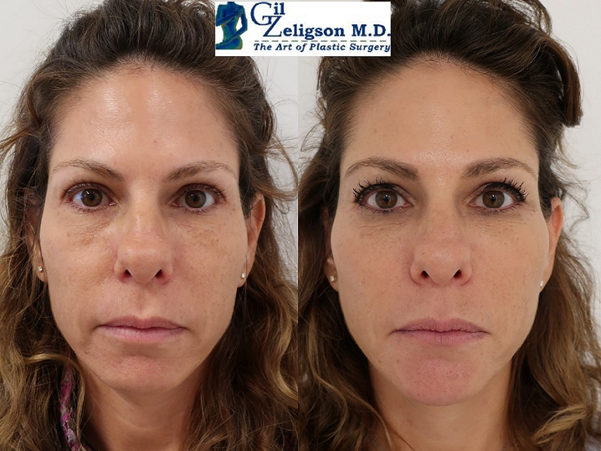 Dr. Gil Zeligson - Facial Sculpturing Hyaluronic acid