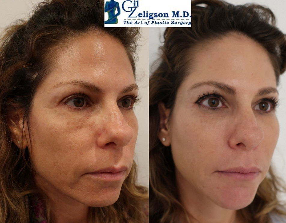 Dr. Gil Zeligson - Facial Sculpturing Hyaluronic acid