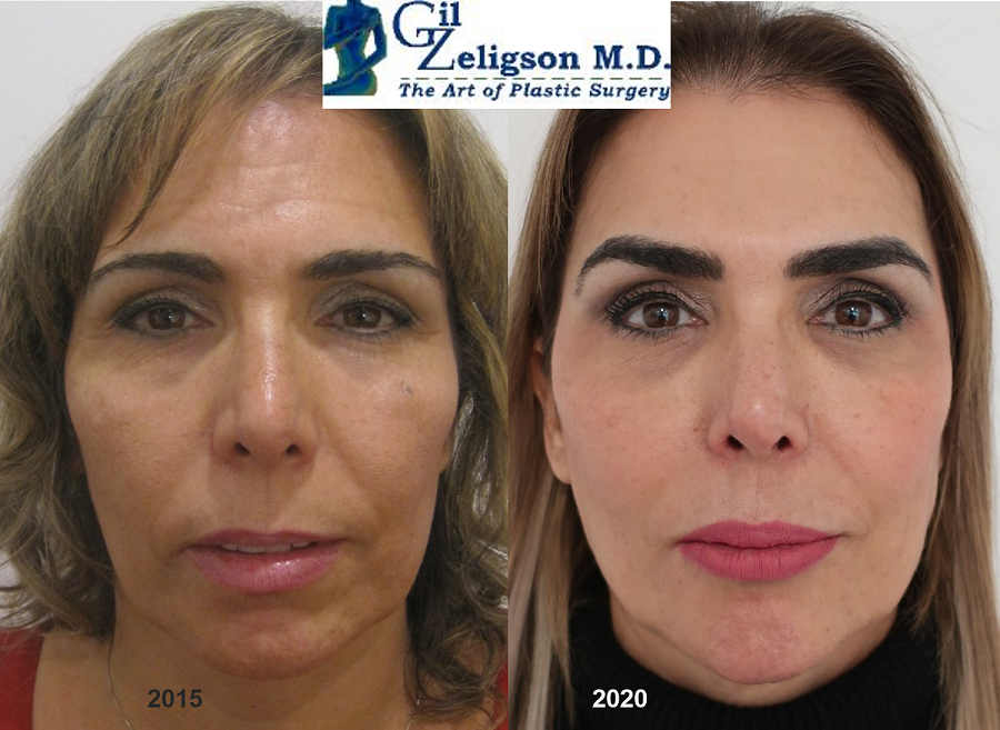 Dr. Gil Zeligson - Facial Sculpturing Hyaluronic acid