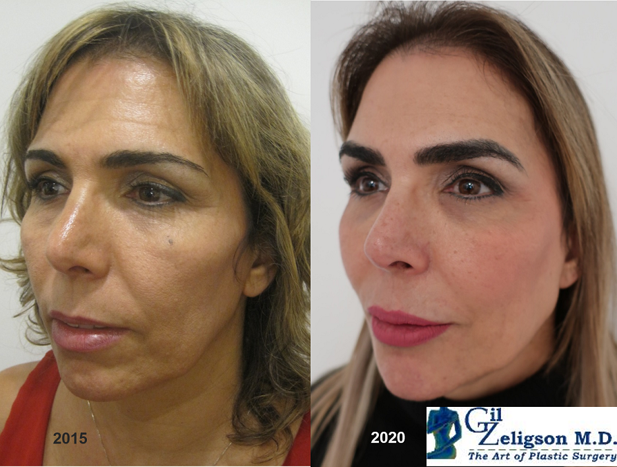 Dr. Gil Zeligson - Facial Sculpturing Hyaluronic acid