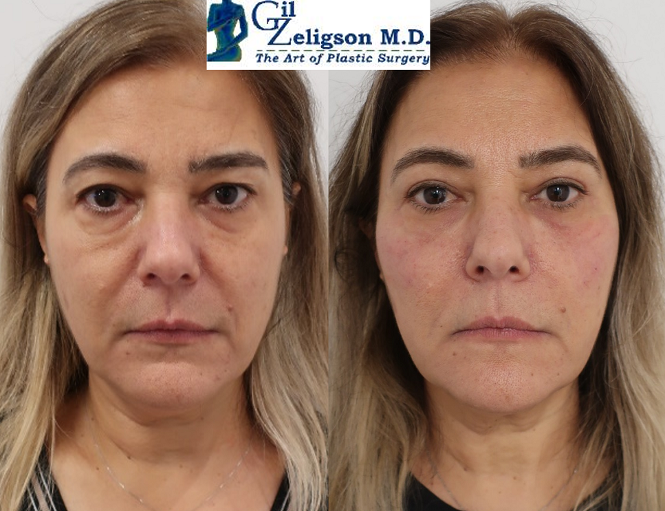 Dr. Gil Zeligson - Facial Sculpturing Hyaluronic acid