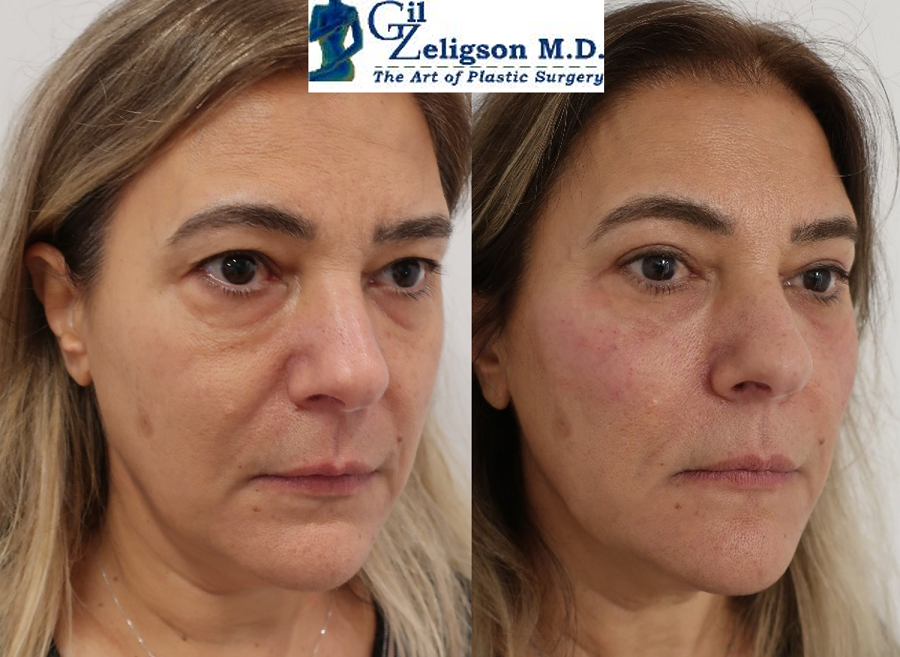 Dr. Gil Zeligson - Upper and Lower Eyelids