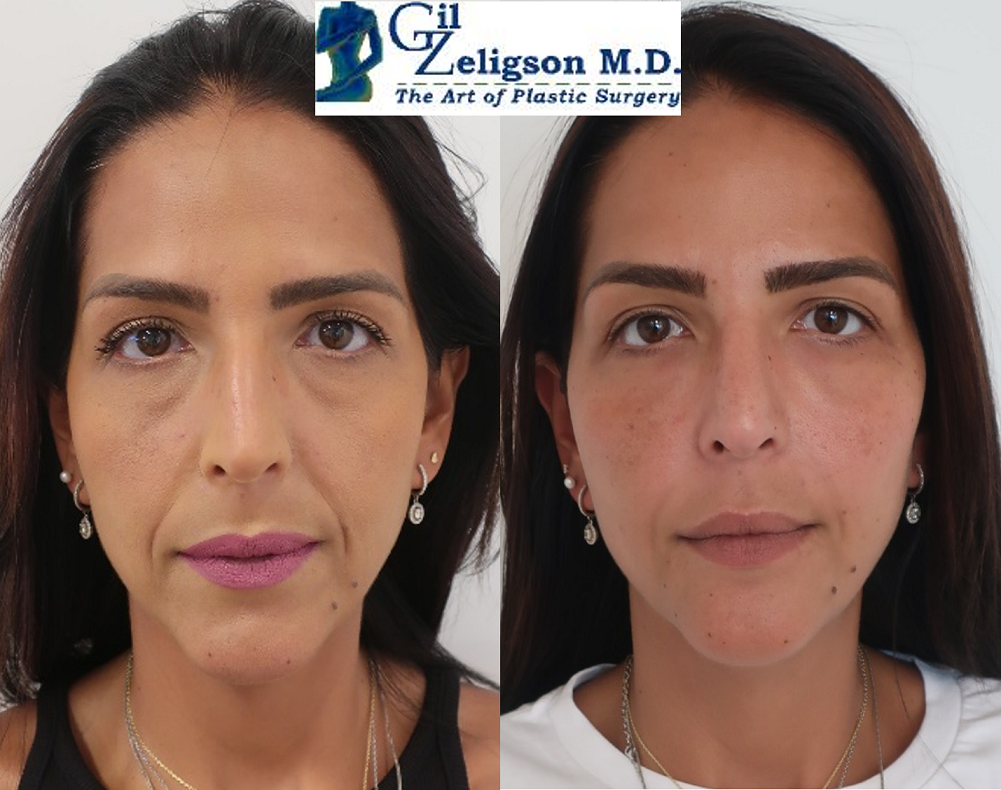 Dr. Gil Zeligson - Facial Sculpturing Hyaluronic acid