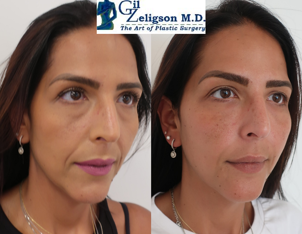 Dr. Gil Zeligson - Facial Sculpturing Hyaluronic acid