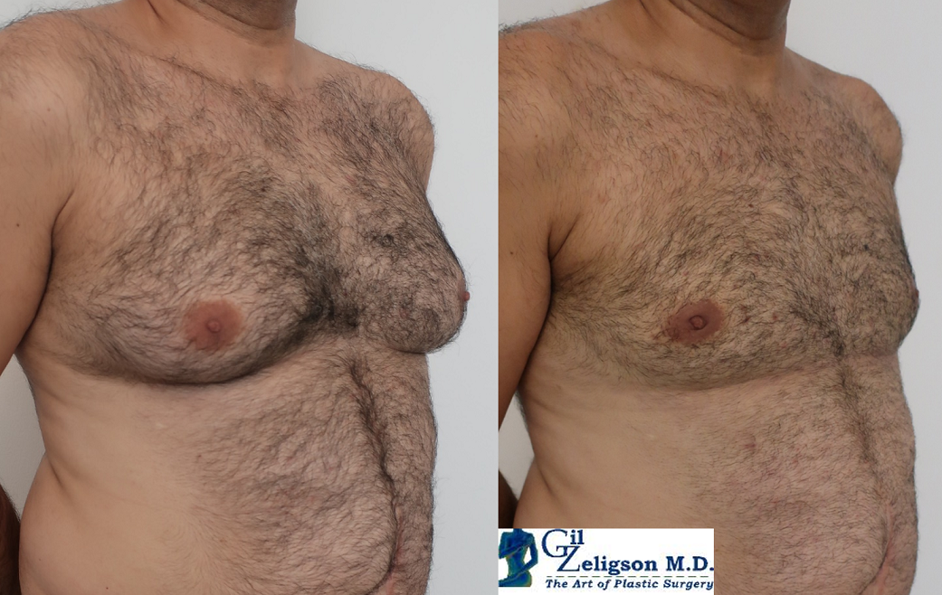 Dr. Gil Zeligson - Gynecomasty