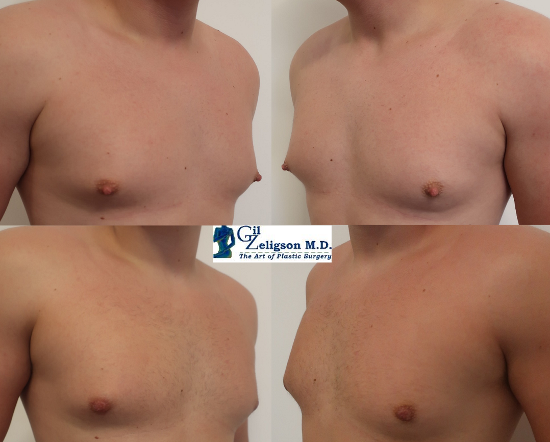 Dr. Gil Zeligson - Gynecomasty