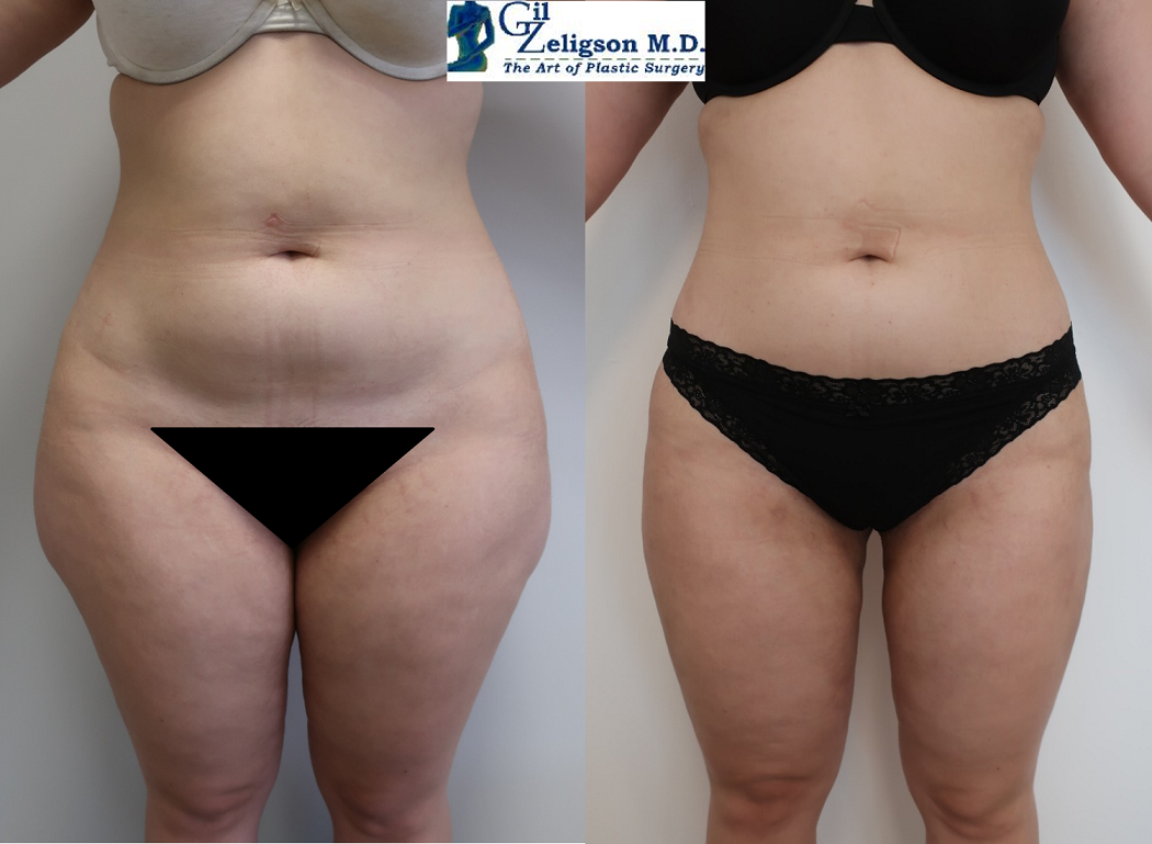 Dr. Gil Zeligson - Liposuction