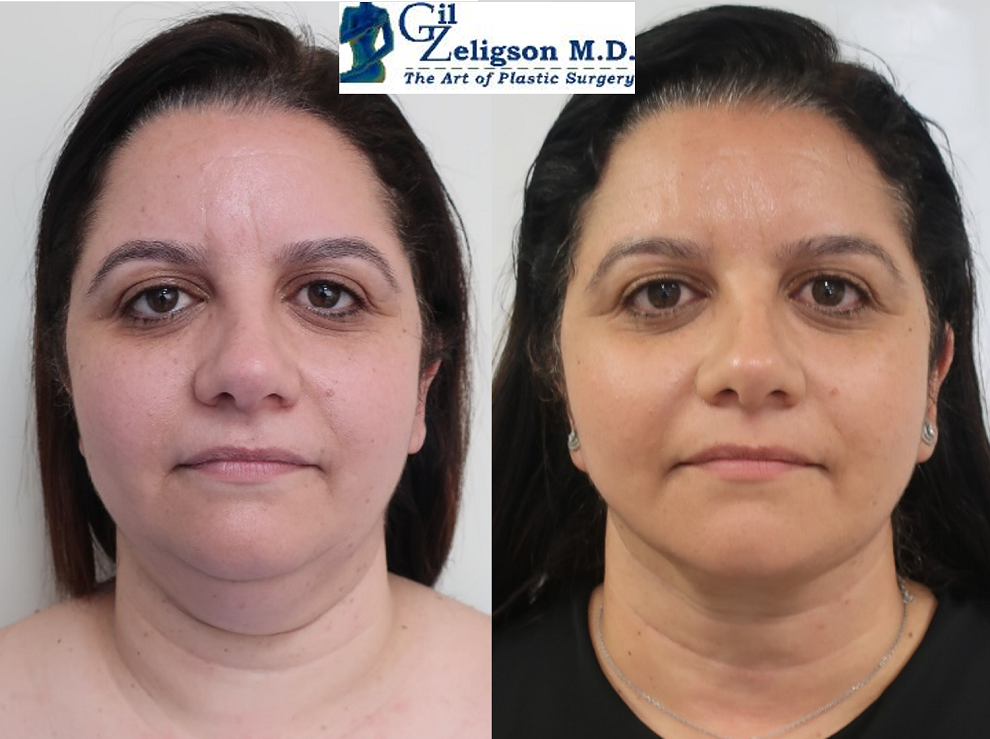Dr. Gil Zeligson - Facelift
