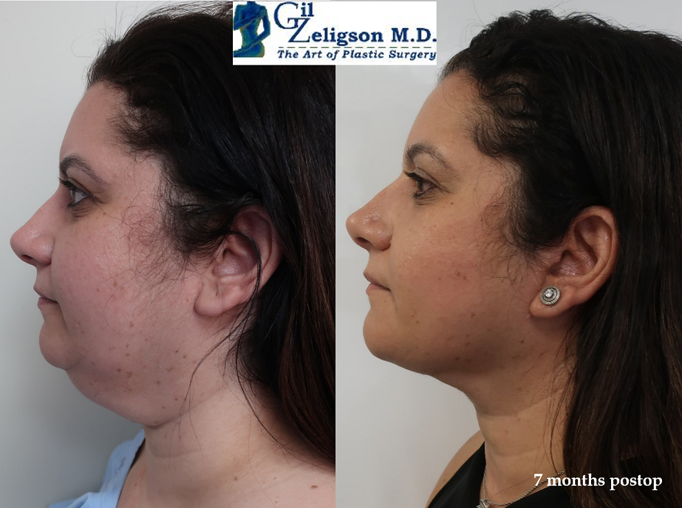Dr. Gil Zeligson - Facelift