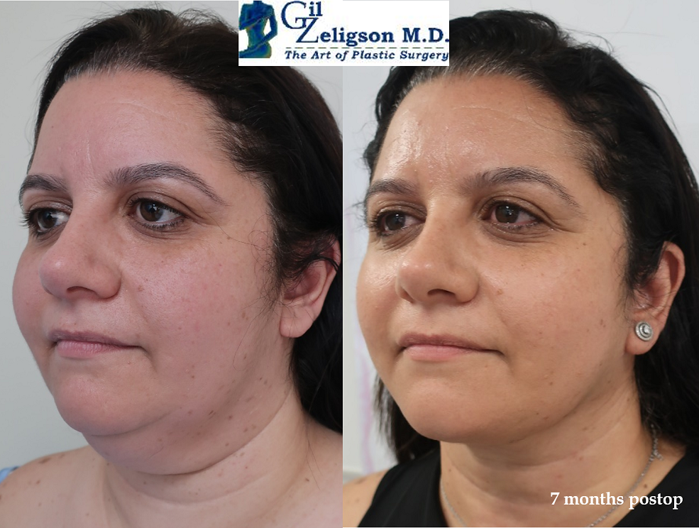 Dr. Gil Zeligson - Facelift