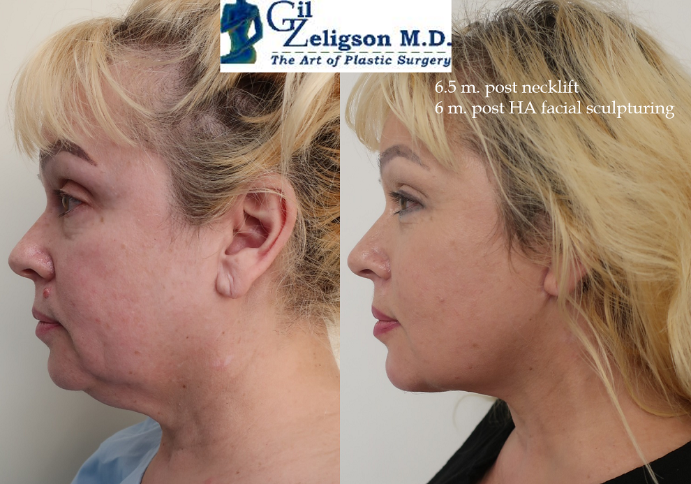 Dr. Gil Zeligson - Facelift