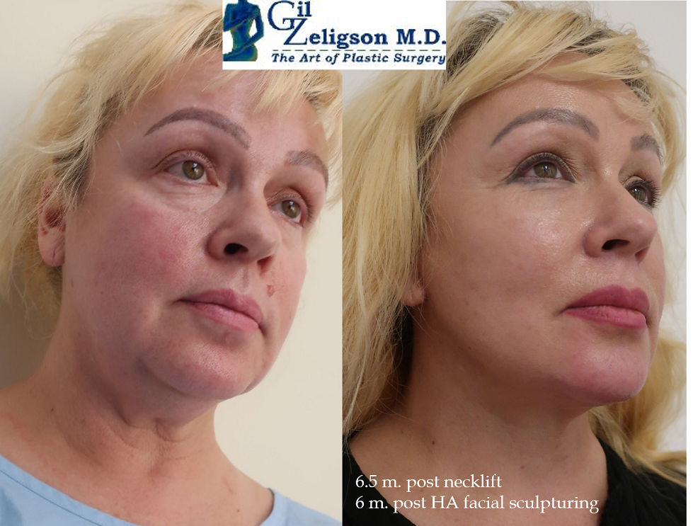 Dr. Gil Zeligson - Facelift